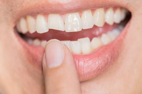 Fractura dental